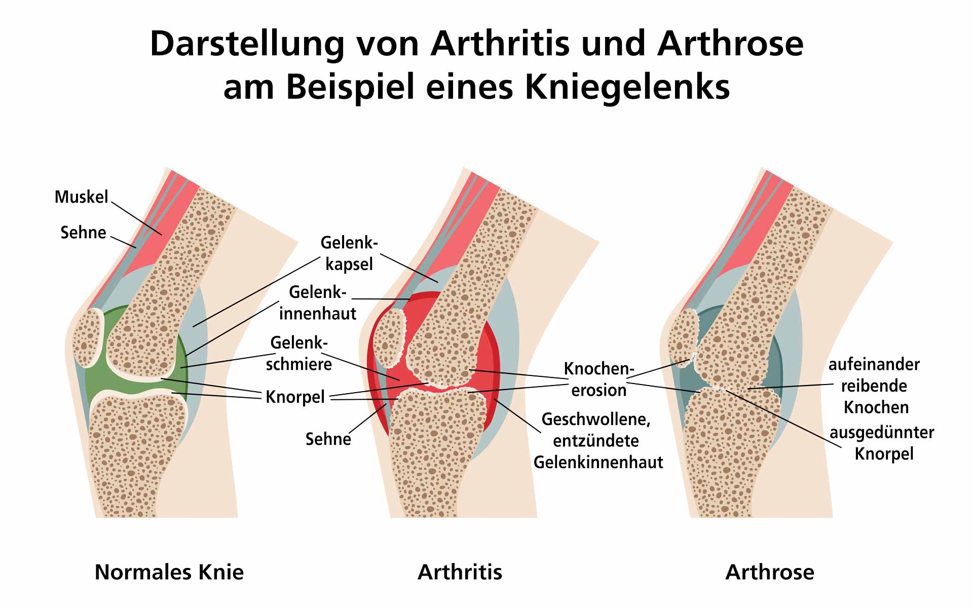 Unterschied von Arthrose und Arthritis